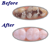 Before and After beautiful dental crown near Palm Beach Gardens