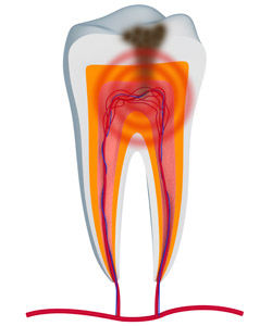 Infected Pulp is Removed with Root Canal Treatment near Jupiter